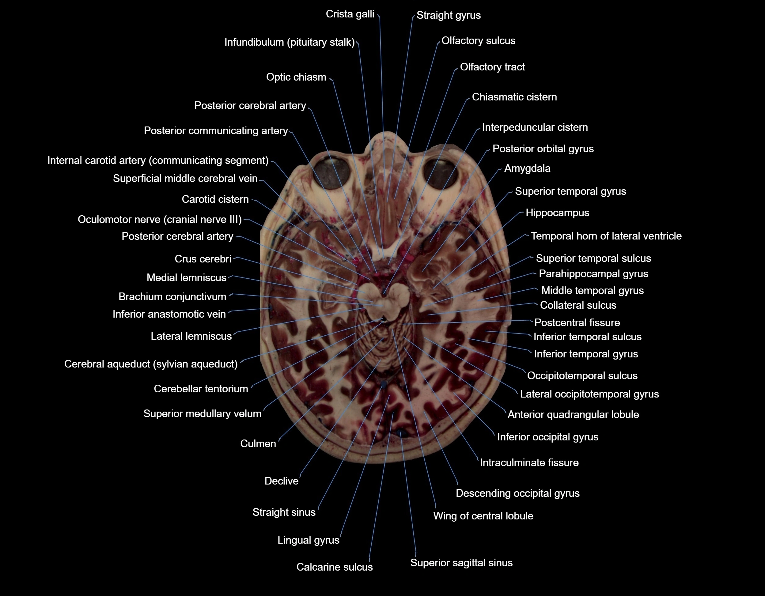 MRI Brain axial cross sectional radiology anatomy 3T image  -img-000033.webp